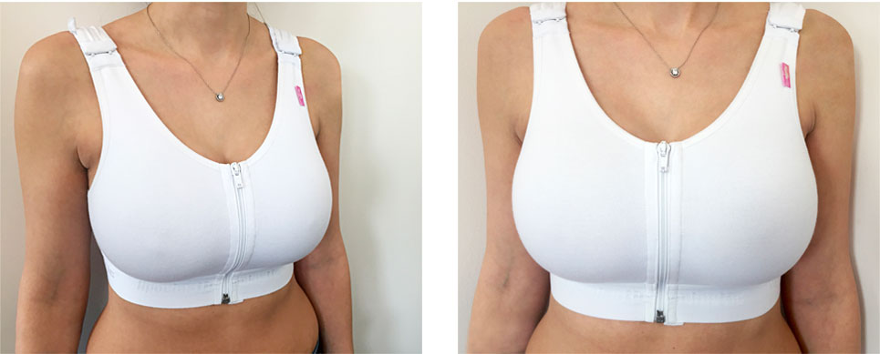 Recovery period after a surgery can be very uncomfortable. Be careful when  choosing your postoperative garments!
